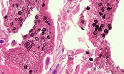 Pneumocystis jirovecii